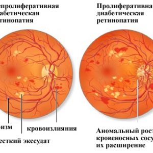 Диагностирование диабетической ретинопатии
