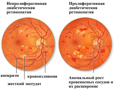 Диагностирование диабетической ретинопатии